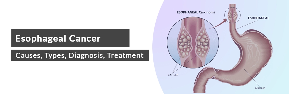 Esophageal Cancer: Causes, Types, Diagnosis, Treatment, Prevention and Cost